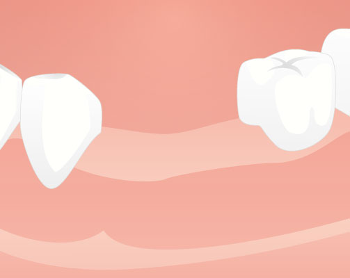 Procedures for implant treatment and a treatment period - Dental Implants Net