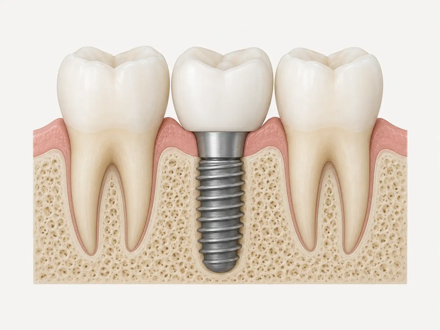 Cross-section of a lower jaw showing an implant fixture in the bone, an abutment at gum level and a crown above it, between two natural teeth